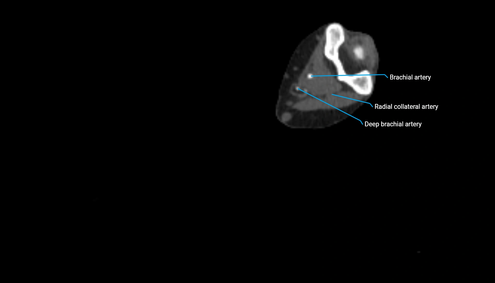 CTA upper limb axial cross sectional anatomy labelled image 195 (2).webp
